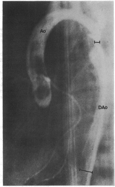 Systolicframe In Lateral Projection Of An Angiogram Of The Ascending