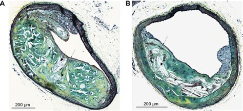 Morphology Of Advanced Atherosclerotic Lesions In The Innominate Artery