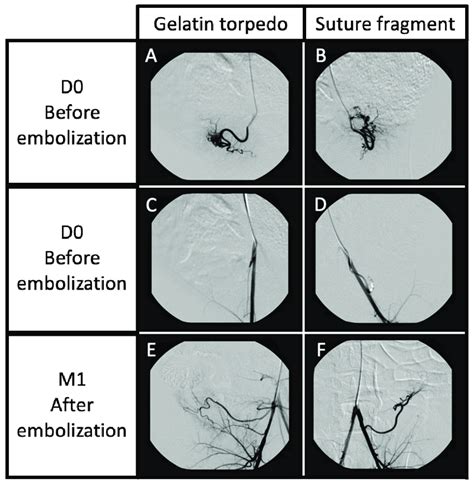 Angiography Controls Before Uterine Embolization A B Just After