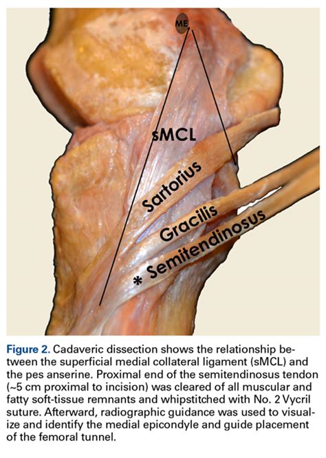 Minimally Invasive Anatomical Reconstruction Of Posteromedial Corner Of