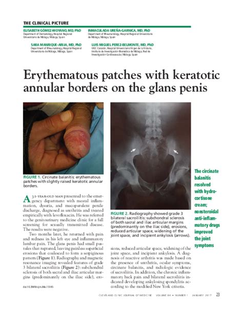 Pdf Erythematous Patches With Keratotic Annular Borders On The Glans Penis Sara Manrique