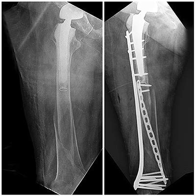 Osteosíntesis con placa helicoidal en las fracturas de fémur distal