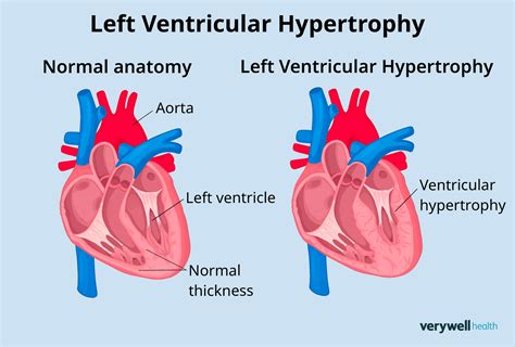 What Causes Left Ventricular Hypertrophy Lvh