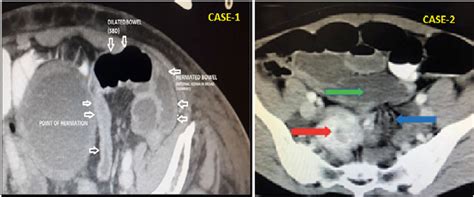 Comparison Of Cect Abdomen Axial Views Case 1 Shows The Point Of Download Scientific Diagram