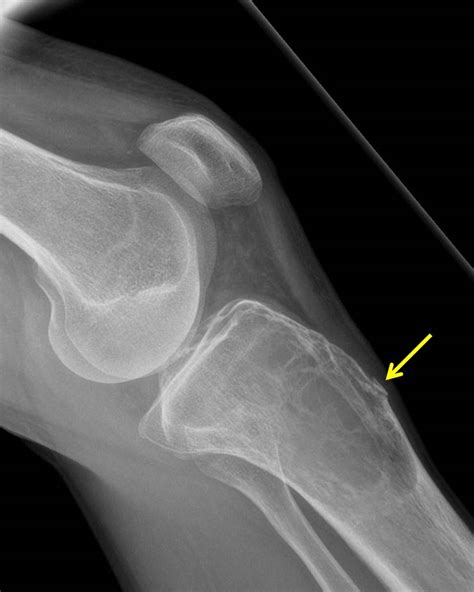 Aneursymal Bone Cyst Radiology Cases