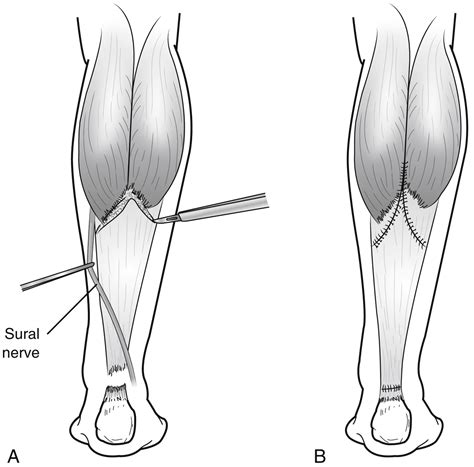 Achilles Tendon Rupture Repair | Musculoskeletal Key