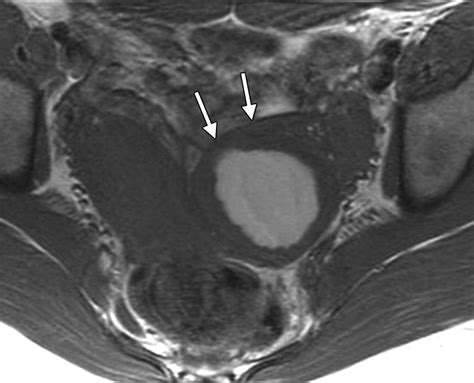 Nonovarian Cystic Lesions Of The Pelvis Radiographics