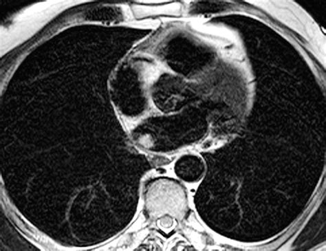 Mr Imaging Of Cardiac Tumors Radiographics