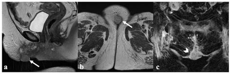 Cancers Free Full Text Mri In The Evaluation Of Locally Advanced Vulvar Cancer Treated With