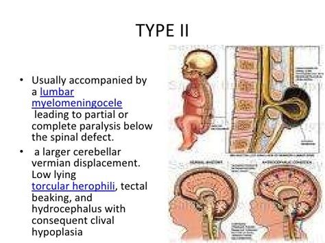 Crazy Mommy: Day 2 and all about Chiari Malformation.