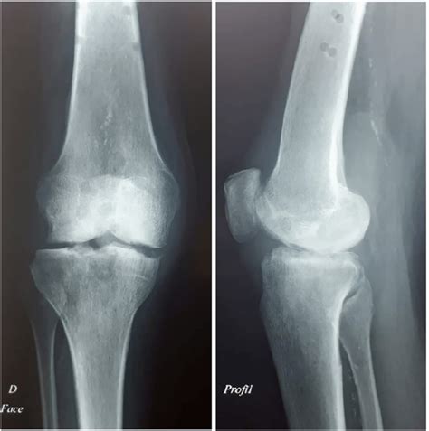 An X Ray Of The Knee After Removal Of The External Fixator Download