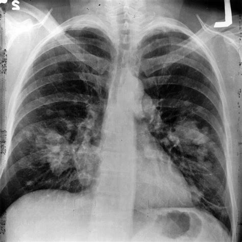 Hemoptysis — Taming the SRU