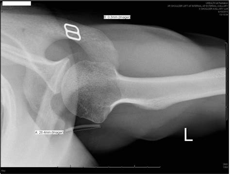 Axillary Migration Of Nexplanon® Case Report Contraception