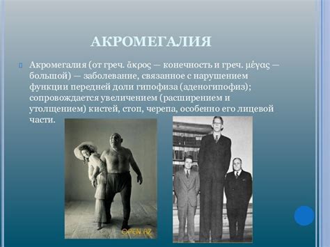 Акромегалия