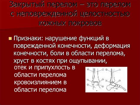 Перелом кости - презентация онлайн