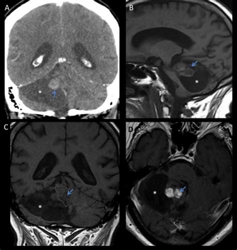 Non Contrast Axial Ct Scan A Demonstrated An Hyperdense Lesion With Download Scientific