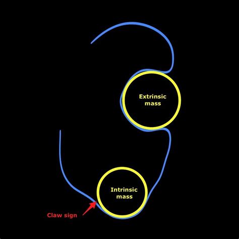 Claw Beak Sign To Indicate Its Origin Radiology Signs