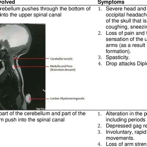 Classification Of Arnold Chiari Malformation Download Scientific Diagram