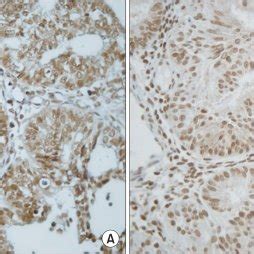 Survivin Cytoplasmic A And Nuclear B Immunohistochemical Staining