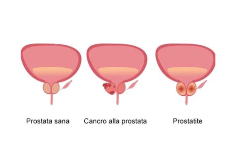 Prostatite Sintomi Cause E Cura Per La Prostata Infiammata