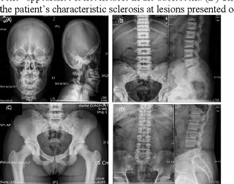 Figure From A Case Of Autosomal Dominant Osteopetrosis Type With A