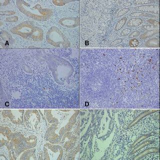 Expression Of IDO And Bin1 In Colon Cancer IDO Is Expressed In Primary