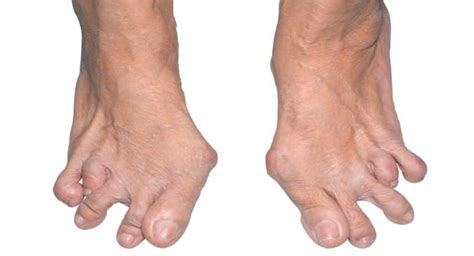 How Rheumatoid Arthritis Affects The Foot And Ankle Read Health Related Blogs Articles And News