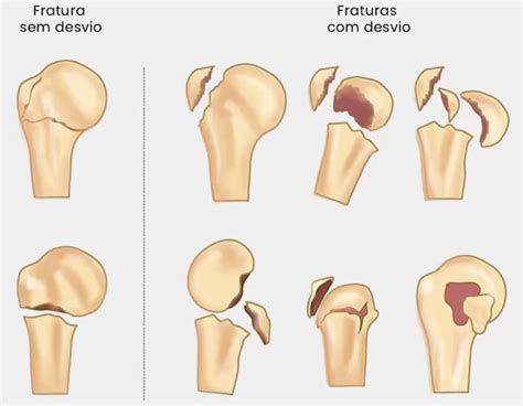 Fratura Umero Proximal Cid Braincp