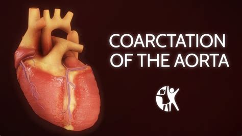 Coarctation Of The Aorta Youtube