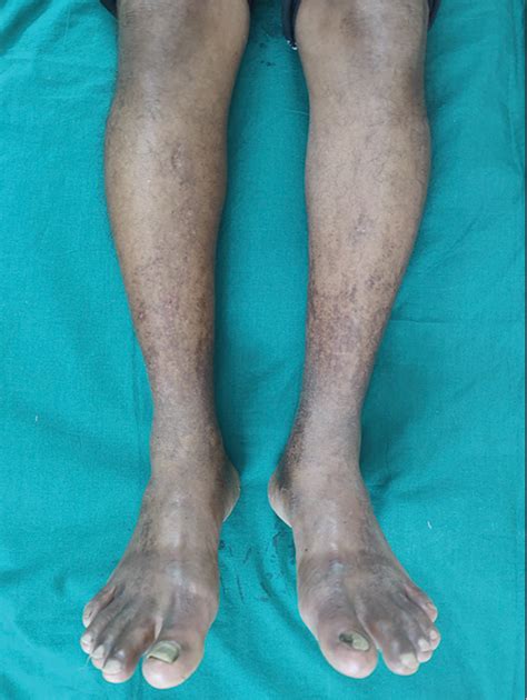 Pigmented Purpuric Dermatosis A Dermoscopic And Management Perspective