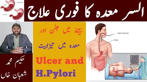 Stomach Ulcer Ka Ilaj Hakeem Muhammad Shaban Khan Maida Ki Sozish