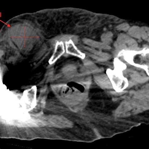 Axial View Of Right Femoral Hernia Note The Significant Image