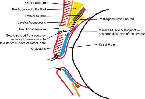 Anterior Approach Levatorpexy For Correction Of Congenital Ptosis