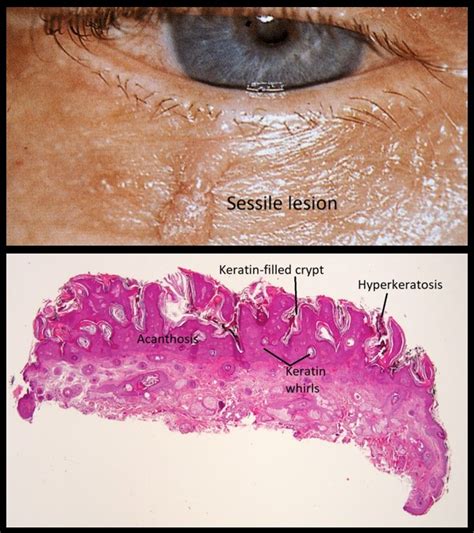 Acrochordon Histology