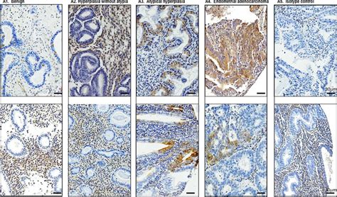 Aldh1 Is Expressed In Premalignant Endometrium Immunohistochemical