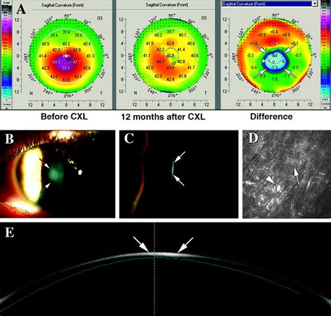 Marked Remodelling Of The Anterior Corneal Surface Following Collagen