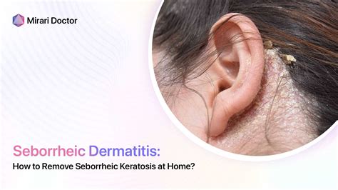 How To Remove Seborrheic Keratosis At Home