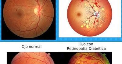 Cl Nica De Ojos Oftalmic L Ser Retinopat A Diab Tica