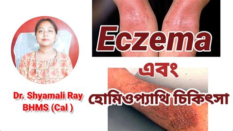 Different Types Of Eczema And Homeopathic Treatment এগজিমার প্রকারভেদ ও