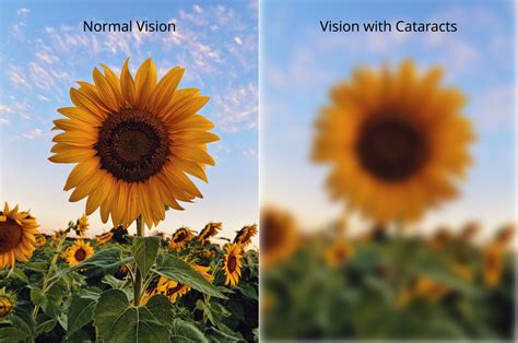 How Do I Know If I Have Cataracts Gulf Coast Vision Center