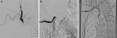 Figure2 Angiographic Findings Of Subclavian Artery Occlusion A Shows