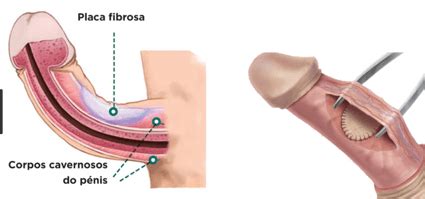 Doen A De Peyronie Hospital Amaral Carvalho Urologia Ja