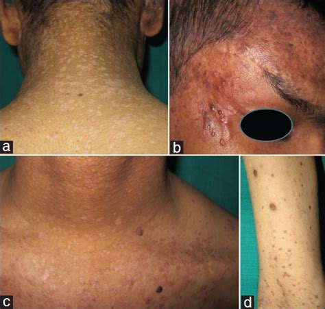 Epidermodysplasia Verruciformis An Unusual Malignant Transformation