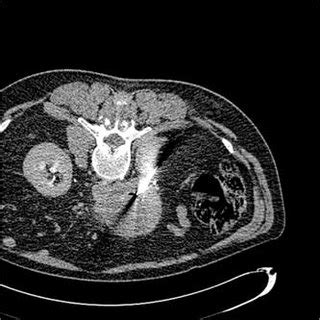 CT Guided Percutaneous Needle Biopsy Of A Retroperitoneal Mass