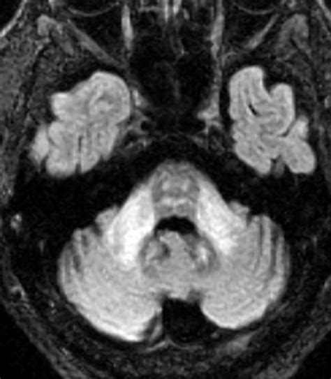 Adult Leukodystrophies A Step By Step Diagnostic Approach RadioGraphics