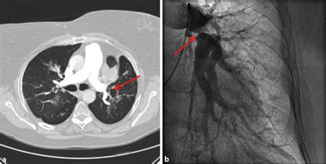 Compression Of The Pulmonary Artery A Case Of A 60 Year Old Female