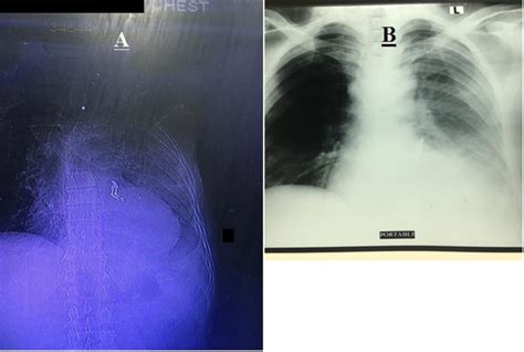 Visual Of Patient S Chest X Ray Pa View Showing Foreign Body Lodged