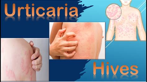 Urticaria Hives Dermatology Types Causes Symptoms Diagnosis And Treatment Youtube