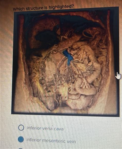 Solved Which Structure Is Highlighted Inferior Vena Chegg