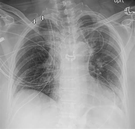 Case 287 Intrathoracic Migration Of A Breast Implant After Video